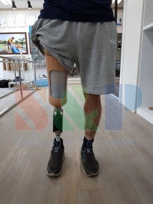 파소니(paso knee) 공압식 슬관절이단의족 착용사