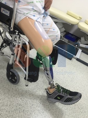 3R60 유압식 다축 무릎관절 슬관절의족 착용사례